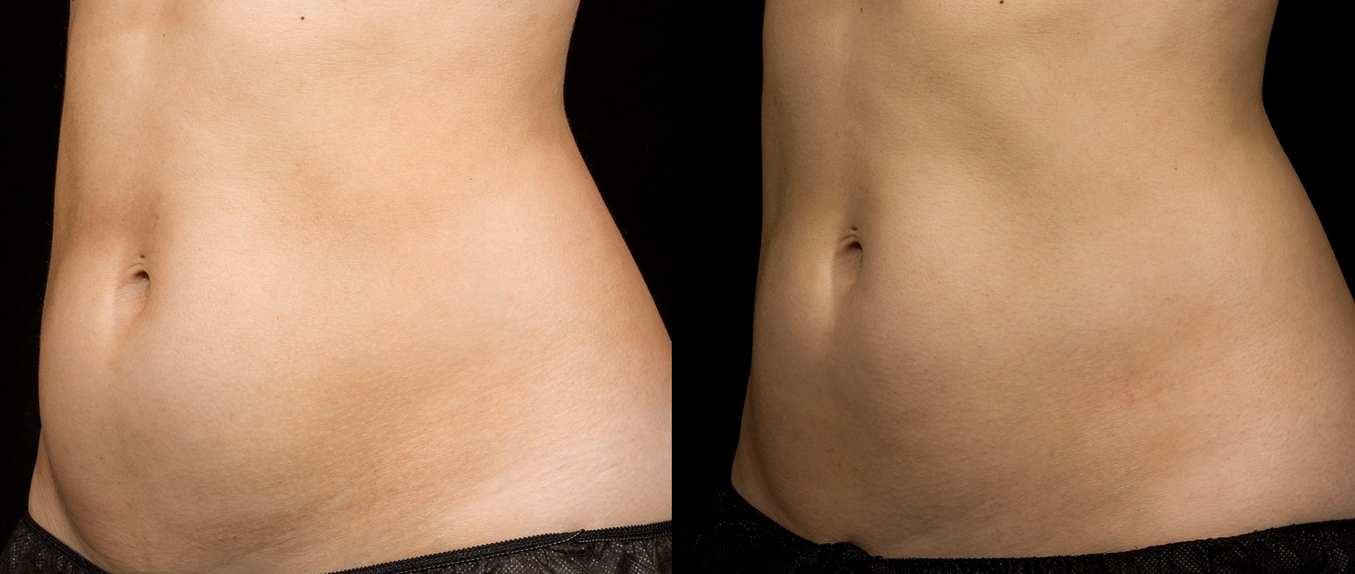 SculpSure before after 01