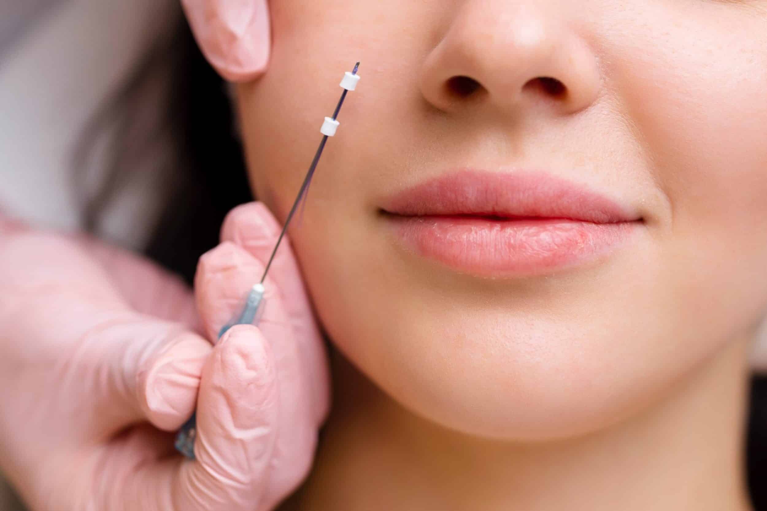 Face,Lifting,Pdo,Suture,Operation.,Innovative,Technique,Of,New,Thread