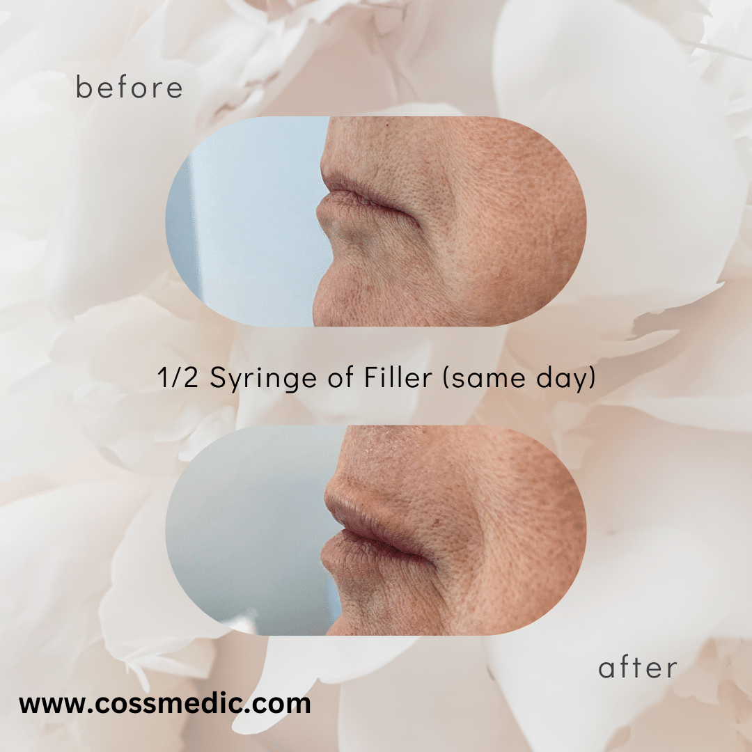 Before and After Image: 12 syringe of Filler - left-side