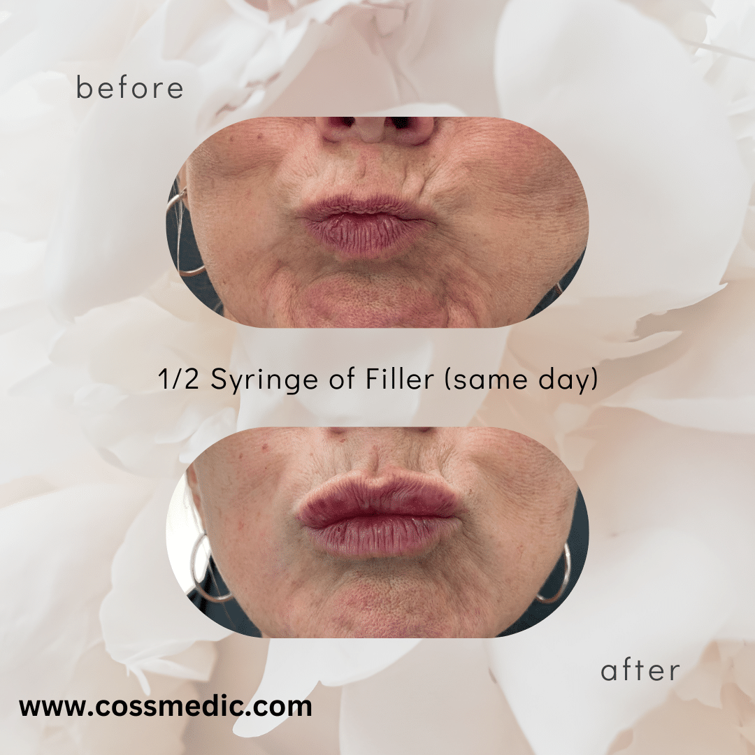 Before and After Image: 12 syringe of Filler - front