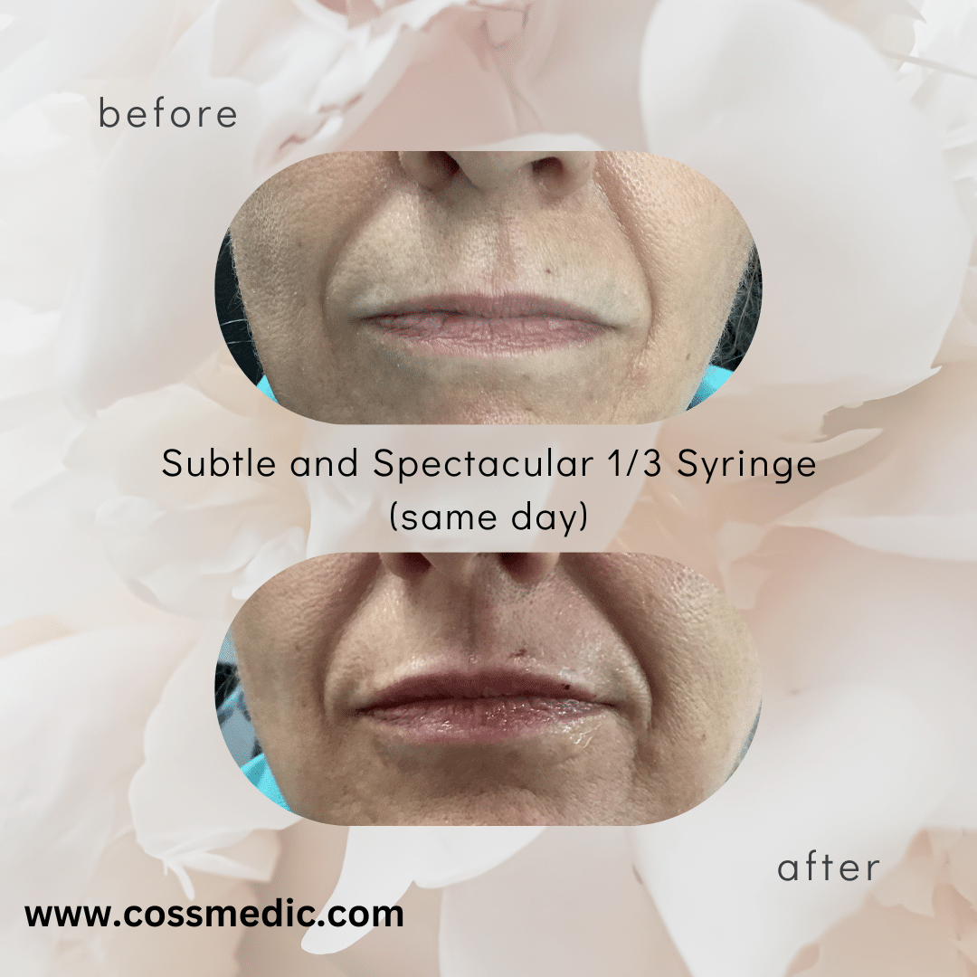 Before and After Image: 12 syringe of Filler - front