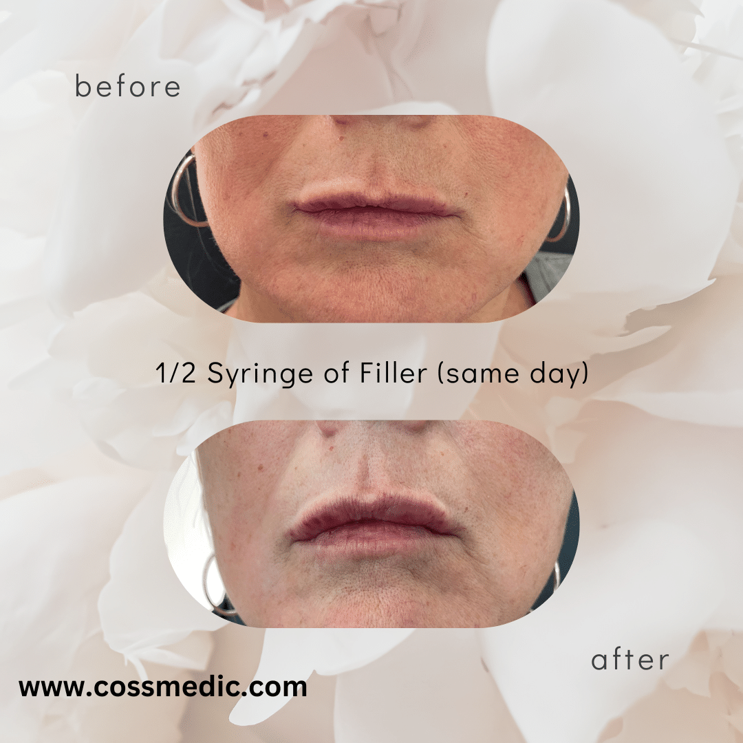 Before and After Image: 12 syringe of Filler - front