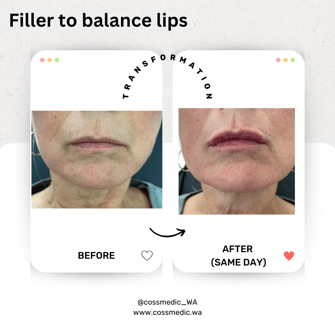 Before and After Image: Filler to balance lips - front