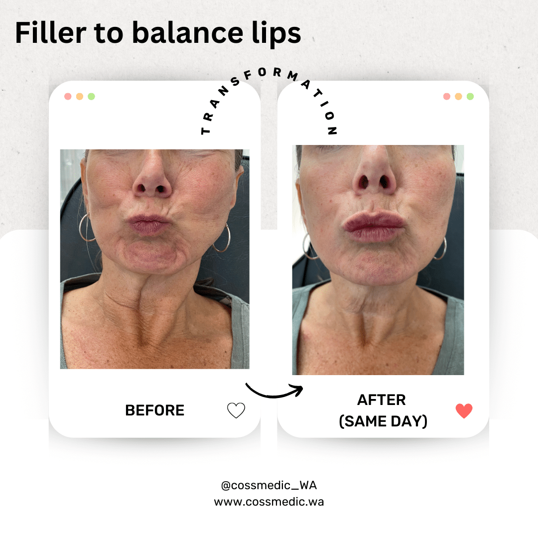 Before and After Image: Filler to balance lips - front