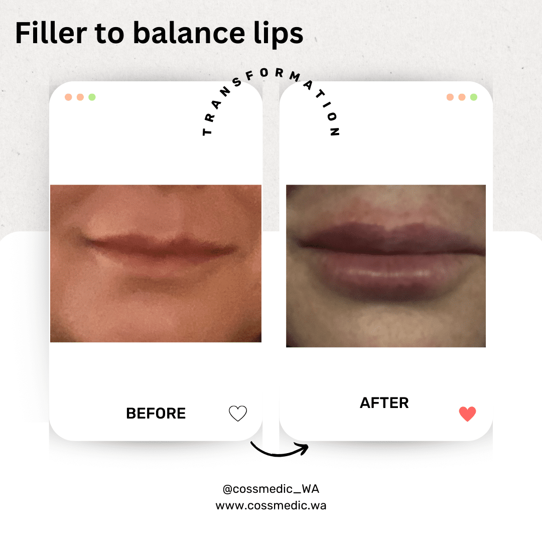Before and After Image: Filler to balance lips - front