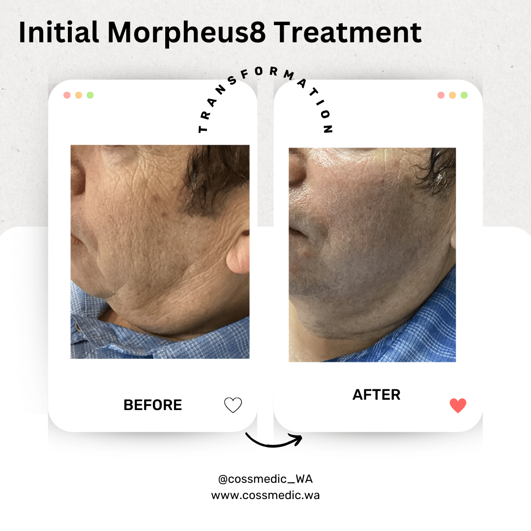 Before and After Image: Initial Morpheus8 Treatment - left-side